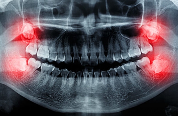 Surgery and extraction of wisdom teeth