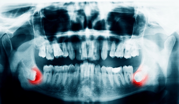 Wisdom tooth surgery on hard tissue