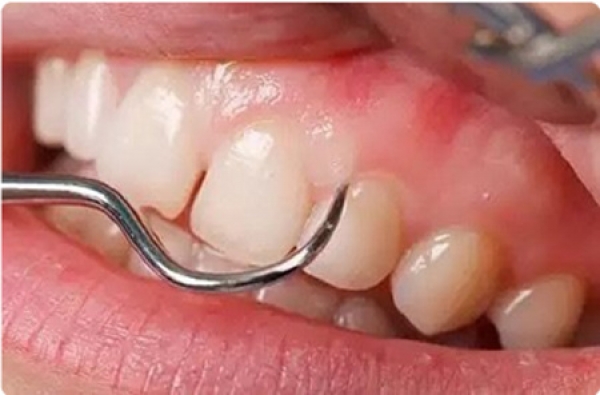 Gum disease surgery