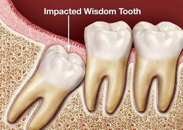 Wisdom tooth surgery in soft tissue