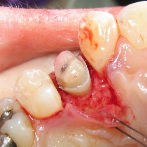 نحوه انجام جراحی افزایش طول تاج دندان