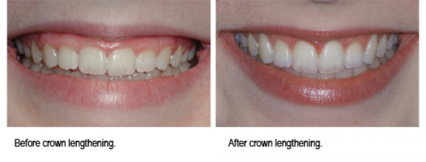 Smile and cosmetic line correction surgery