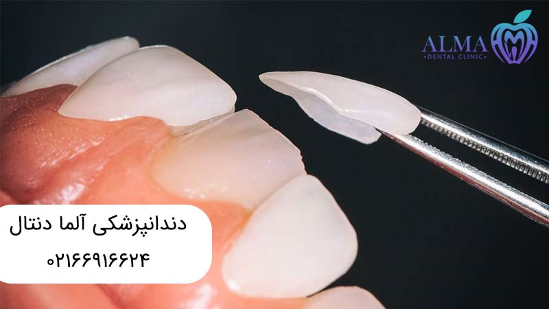کامپوزیت ونیر یا لمینت