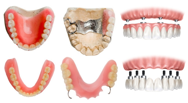 معرفی پروتز دندان و انواع آن