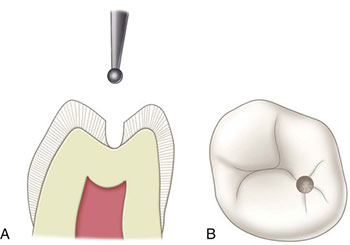 ترمیم و پوسیدگی دندان 