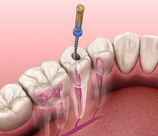 Root canal retreatment RRCT