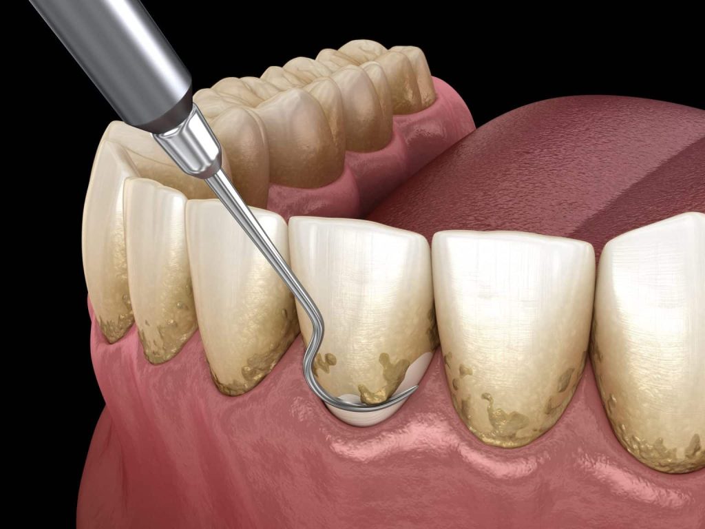 پریودنتیت  دندان