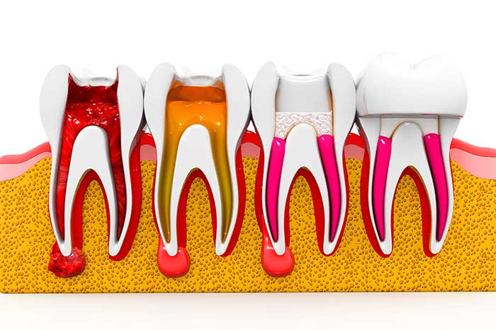 درمان ریشه دندان RCT