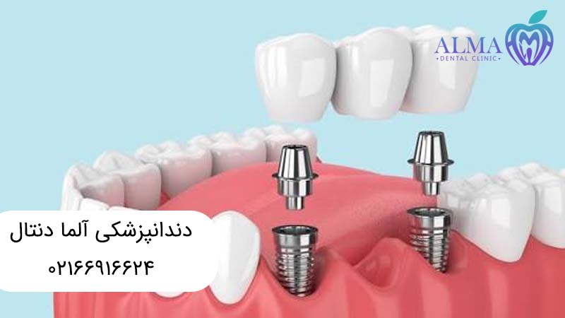 بریج بر پایه ایمپلنت