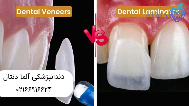 کامپوزیت ونیر یا لمینت
