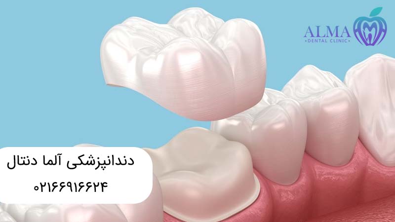 مشکلات مربوط به تعویض روکش دندان