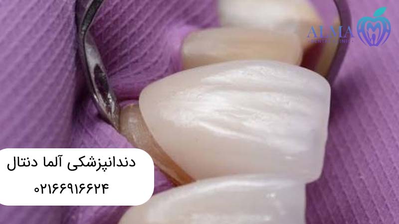 لمینتهای دندانی و تفاوتهای آنها