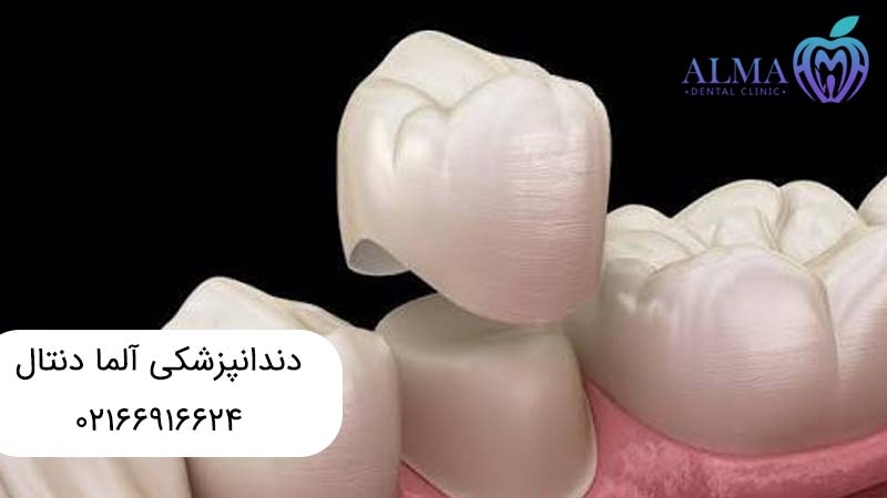 مشکلات مربوط به تعویض روکش دندان
