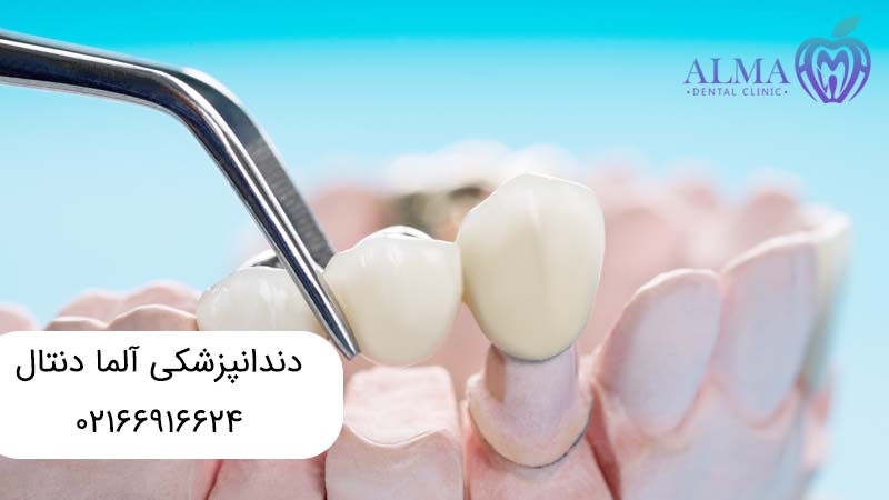 پروتز ثابت دندان