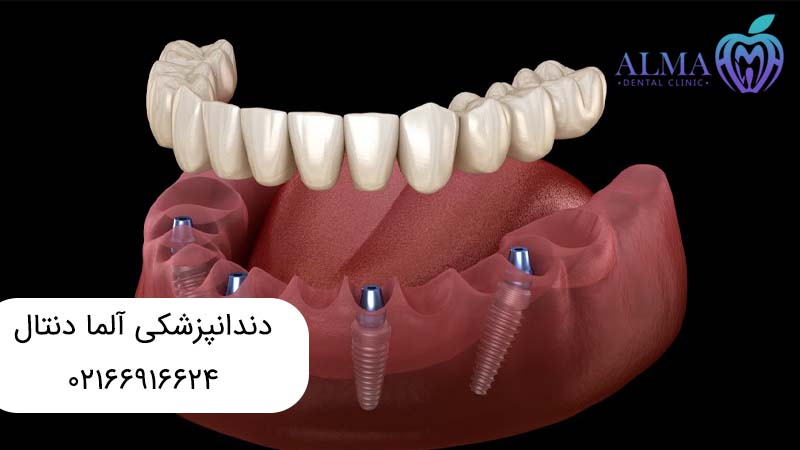 اوردنچر بر پایه ایمپلنت