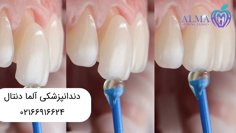 لمینتهای دندانی و تفاوتهای آنها