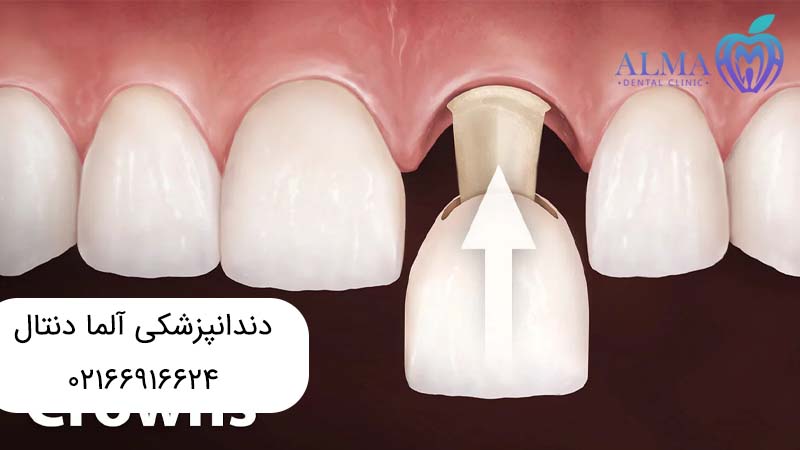 کامپوزیت ونیر یا لمینت