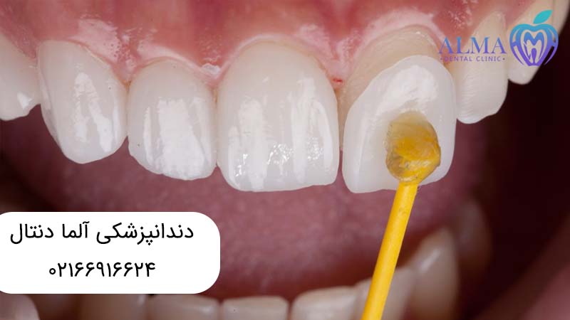 لمینتهای دندانی و تفاوتهای آنها
