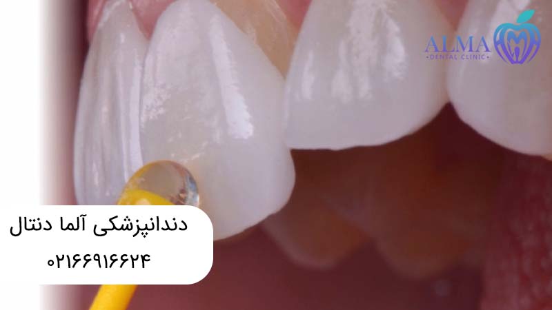 لمینتهای دندانی و تفاوتهای آنها