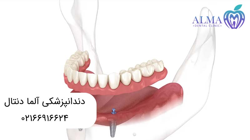 اوردنچر بر پایه ایمپلنت
