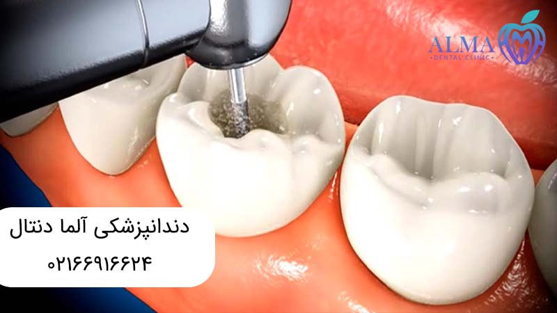 ترمیم دندان