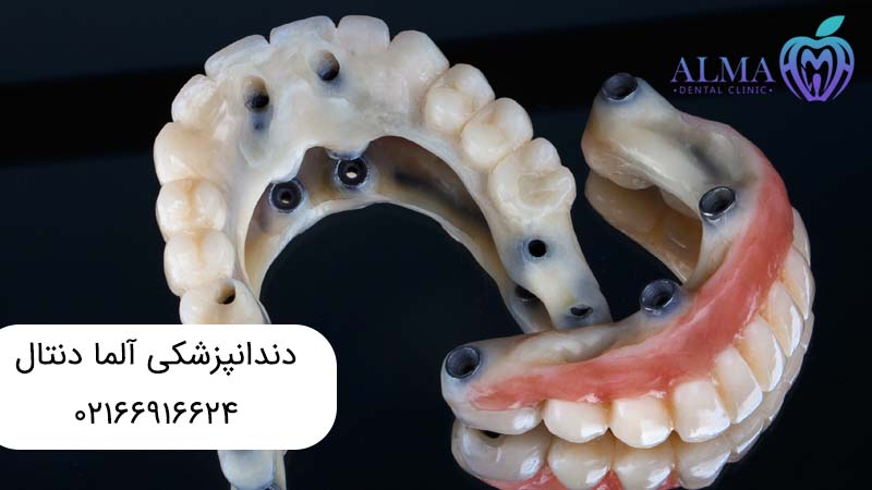 پروتز ثابت دندان