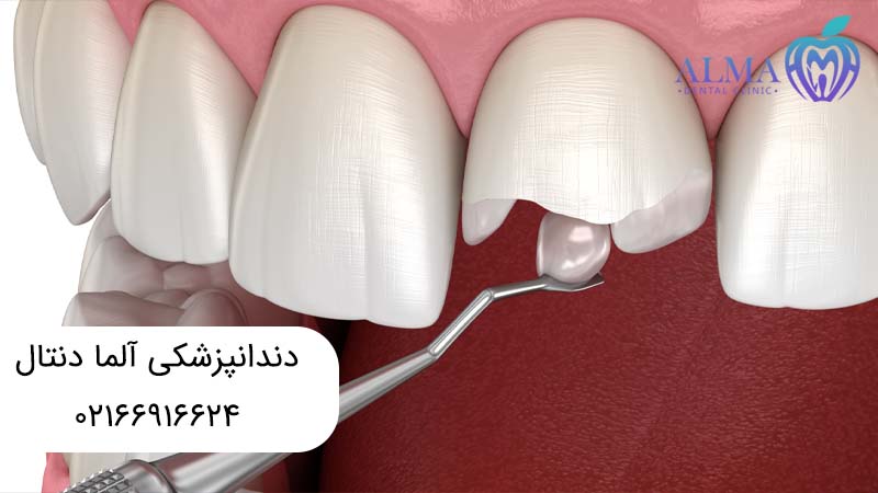 ترمیم دندان