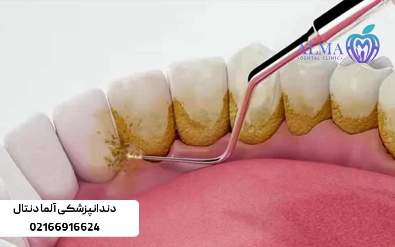 آیا-جرمگیری-برای-دندان-ها-مضر-است؟