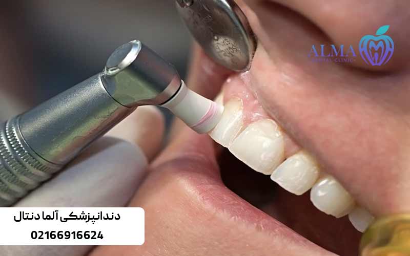 جرمگیری-و-بهداشت-دندان