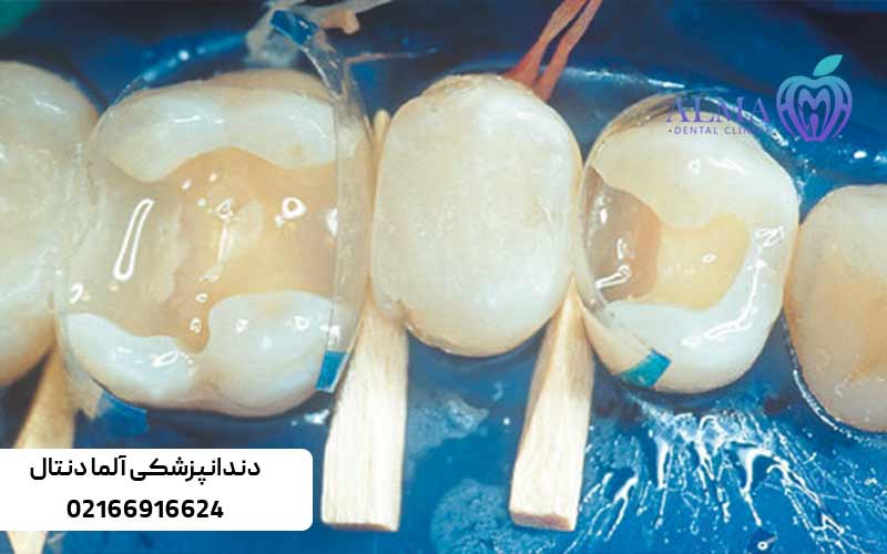 روش-های-ترمیم-دندان-پوسیده