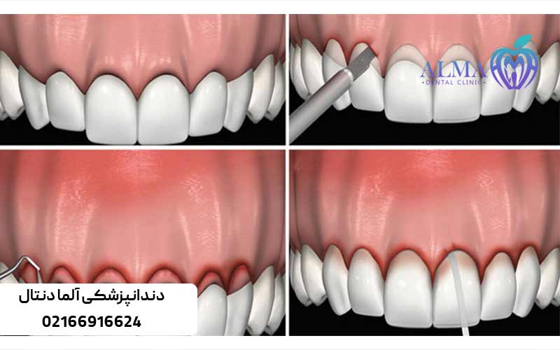 مراحل-انجام-افزایش-طول-تاج-دندان