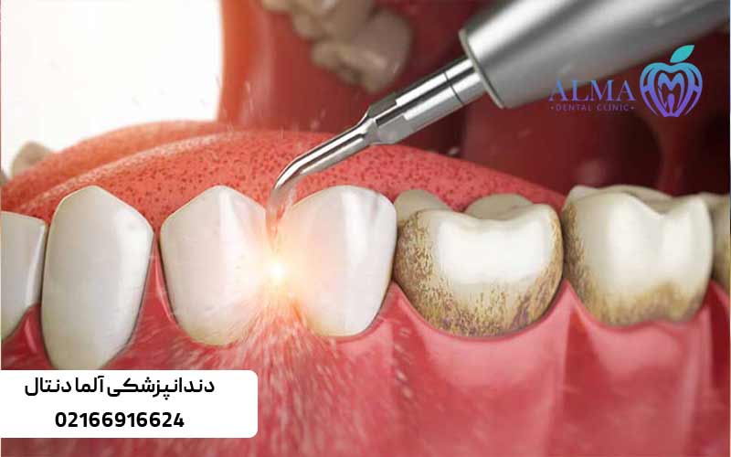 مراحل-جرمگیری-و-بروساژ-دندان