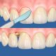 Gingival curettage