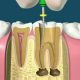 باورهای غلط درباره عصب کشی دندان