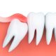 علائم عفونت بعد از کشیدن دندان عقل چیست؟