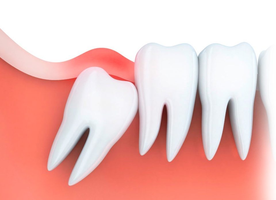 علائم عفونت بعد از کشیدن دندان عقل چیست؟