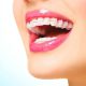 ارتودنسی روی دندان های روکش یا ایمپلنت شده