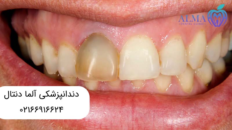 علل خارجی تغییر رنگ دندان
