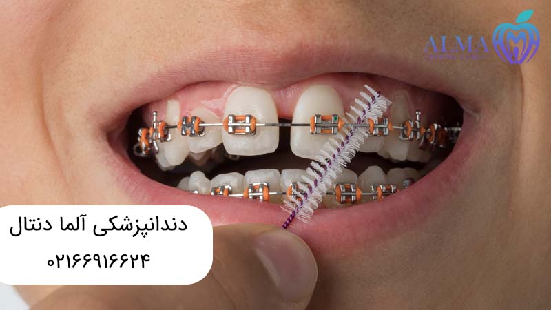 ارتودنسی ثابت چیست؟
