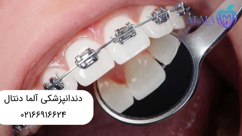 ارتودنسی ثابت چیست؟