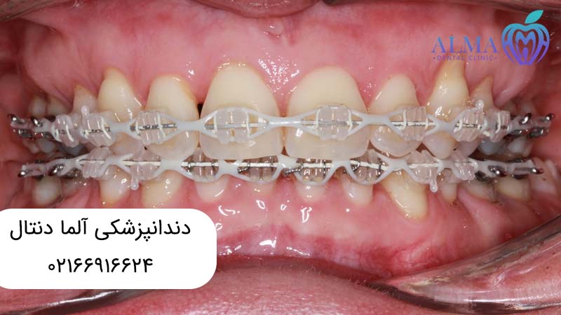 ارتودنسی ثابت چیست؟