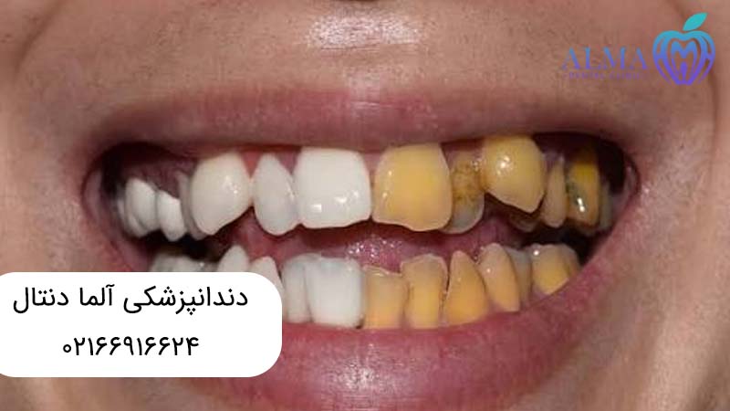 علل خارجی تغییر رنگ دندان