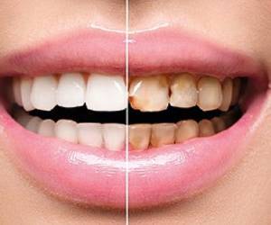 راه های پیشگیری و درمان پوسیدگی دندان جلو