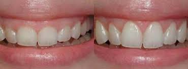 Increase the length of the tooth crown