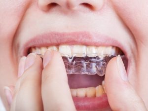 bigstock Young Woman Puts Clear Aligner 137561999
