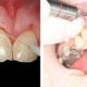 عوارض افزایش تاج دندان