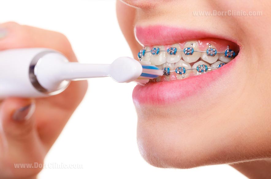 Brushing during orthodontics