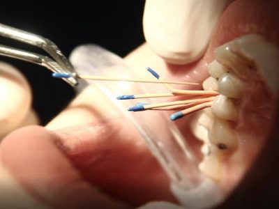 انواع عصب کشی دندان