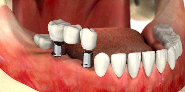 Dental implants in Tehran