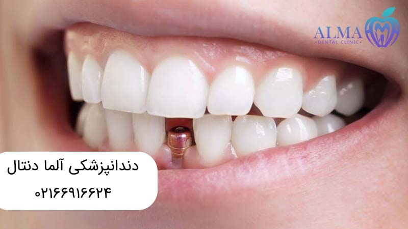 ایمپلنت دندان جلو